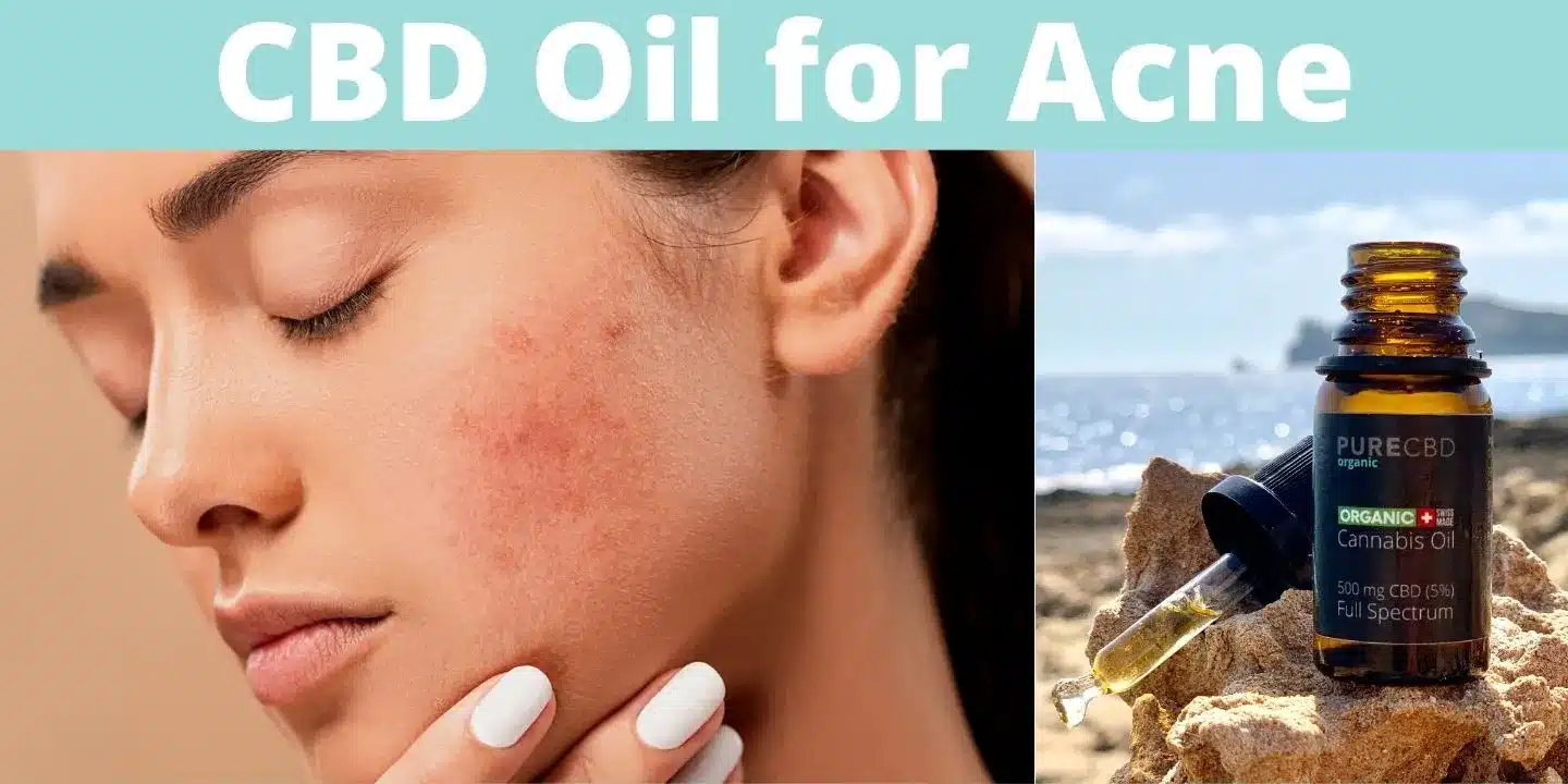 CBD Oil for Acne