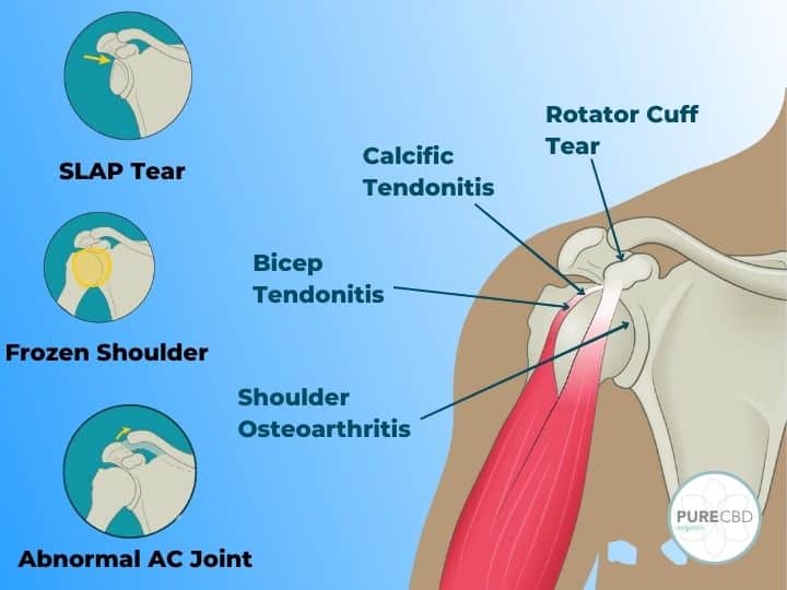 CBD and Shoulder Pain